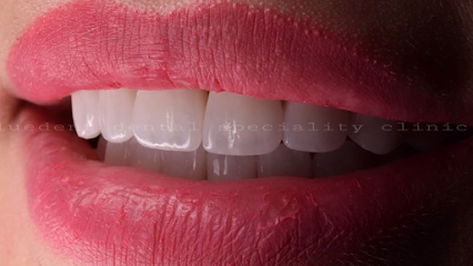 Bluedent Dental Speciality Clinic - Muscat - +968 9133 4555